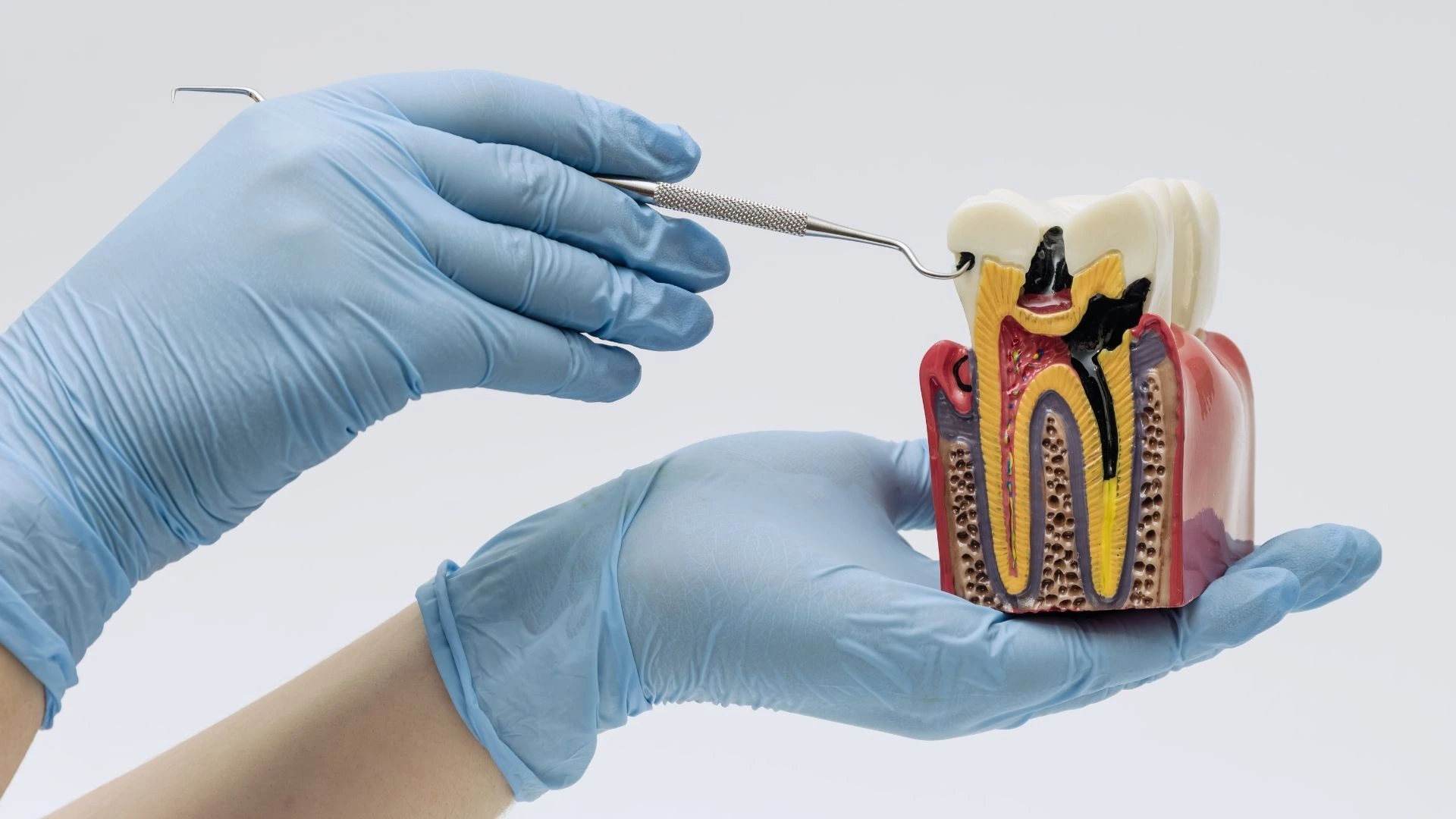 Tratamiento de odontología conservadora en clínica dental de Sanchinarro